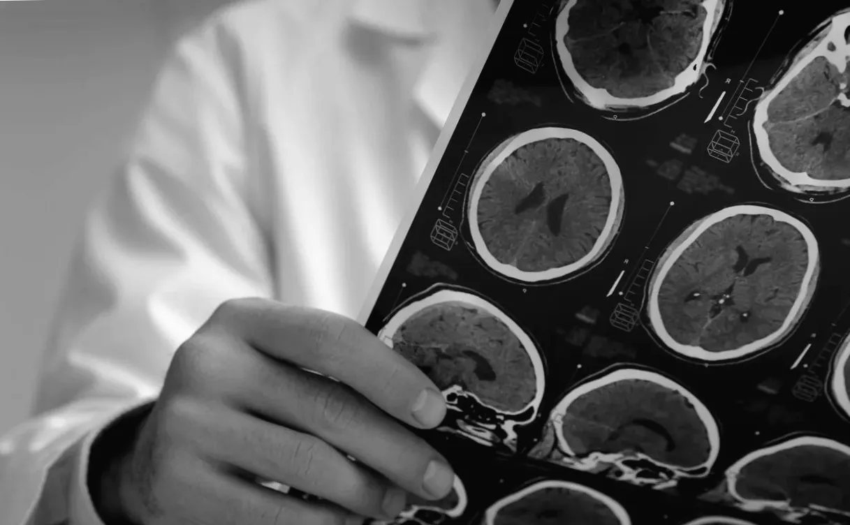 Фаза III випробувань Roche з ліком fenebrutinib у хворих на розсіяний склероз відповідає первинному кінцевому показнику